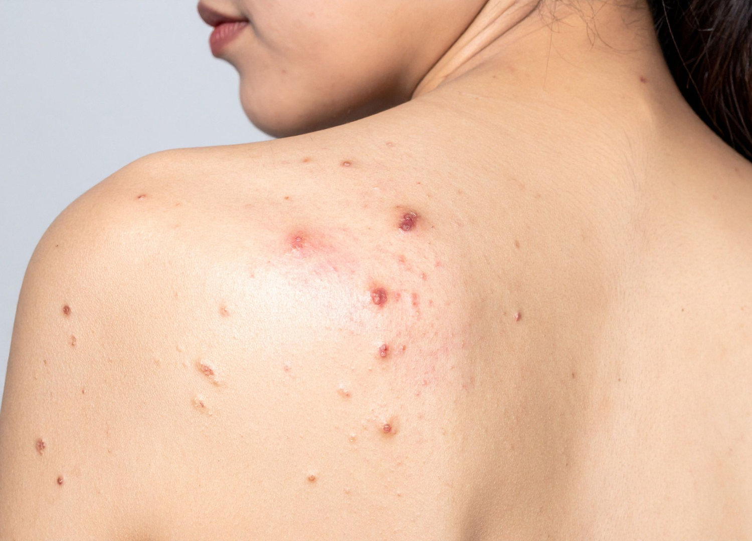 Acne Corporal: causas e prevenção